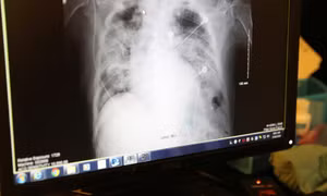 Bệnh nhân Mỹ tử vong sau khi được ghép phổi của người nhiễm virus SARS-CoV-2