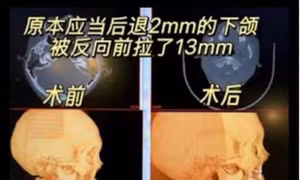 Cô gái Trung Quốc bị biến dạng khuôn mặt sau phẫu thuật chỉnh hàm