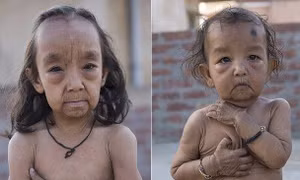 Hội chứng hiếm gặp khiến hai chị em Ấn Độ bị lão hoá, đau khớp như người già