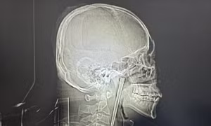 Người đàn ông sống tám năm với đũa kim loại dài 12cm mắc trong cổ họng
