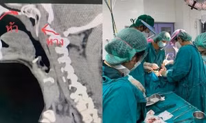 Người đàn ông thoát hiểm sau khi một con cá dài 13 cm chui thẳng vào cổ họng