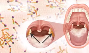 Bệnh nhân nghi ngờ mắc bạch hầu ở Hà Tĩnh có kết quả xét nghiệm âm tính