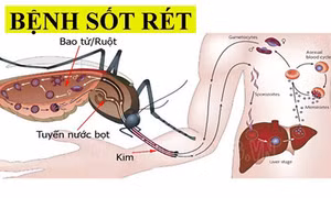 Hướng đến loại trừ sốt rét tại Việt Nam vào năm 2030