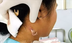 Đồng Nai ghi nhận ca bệnh từ vi khuẩn Whitmore đầu tiên