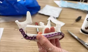 Ứng dụng công nghệ 3D trong tái tạo xương hàm dưới