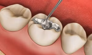 Nhiều nước kêu gọi cấm vật liệu trám răng chứa thủy ngân trước năm 2030