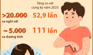 Số ca mắc sởi cao hơn cùng kỳ 111 lần, đã có 5 ca tử vong