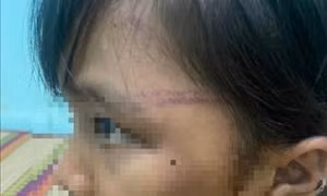 Xác minh việc bé gái nghi bị bạo hành ở Bình Phước