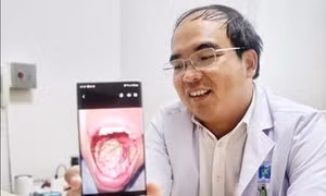 Tái tạo lưỡi cho nhiều bệnh nhân ung thư