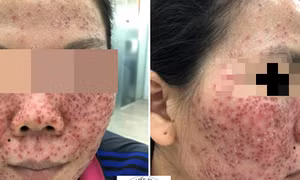 Hiểm họa làm đẹp bằng sản phẩm lột da
