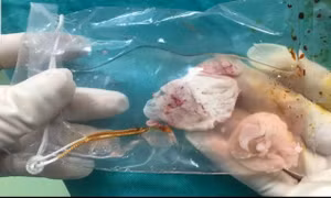 Ổ sán lớn trong não một người đàn ông 