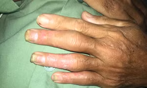 Toàn thân sưng đỏ, khớp biến dạng vì uống thuốc nam điều trị vảy nến