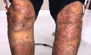 Tự ý bôi thuốc nam để điều trị bệnh vảy nến, bệnh nhân bị sưng phù và lở loét toàn thân