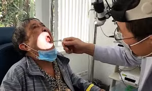 Phẫu thuật lấy khối u xương hiếm gặp chắn ngang vòm miệng cụ bà 79 tuổi