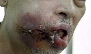  Mặt sưng vù, mưng mủ biến chứng nặng sau khi nặn mụn nhọt 