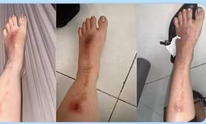 Bắn pháo hoa mừng tiệc tất niên, người phụ nữ bị bỏng nặng
