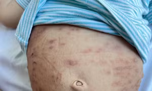 Bé trai mắc bệnh hiếm, nổi hàng trăm mụn nước