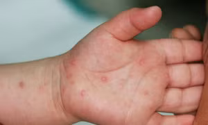 Khống chế, không để bệnh tay chân miệng lây lan diện rộng