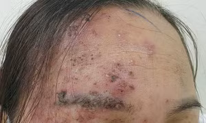  Biến chứng nặng vì tự điều trị bệnh 'giời leo' bằng đắp lá cây và 'đi phán'