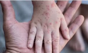 Đức ghi nhận ca mắc đậu mùa khỉ đầu tiên ở trẻ em 