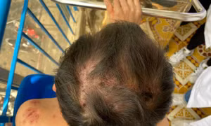 TP Hồ Chí Minh: Phát hiện một trường hợp mắc bệnh lý hiếm gặp, dễ nhầm với bệnh lý dị ứng thuốc