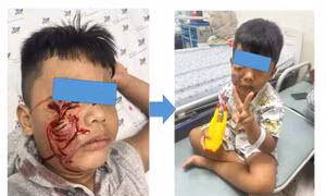 Cấp cứu bé trai 5 tuổi bị chó cắn rách mặt phải khâu 20 mũi 
