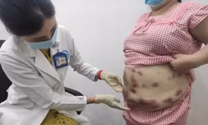 Người phụ nữ bị viêm, chảy mủ vùng bụng, hông đùi vì tiêm chất tan mỡ bụng