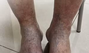 TP Hồ Chí Minh: Phát hiện trường hợp bị bệnh mô liên kết hỗn hợp hiếm gặp, da cứng như gỗ