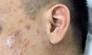 Làm gì để phòng và tránh những biến chứng của bệnh thuỷ đậu?
