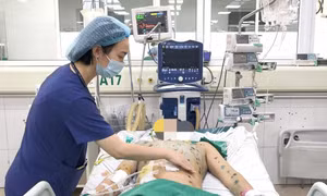 Gia tăng ca mắc thủy đậu, cảnh báo nguy cơ biến chứng nặng
