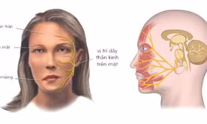 Nhiễm lạnh đột ngột có thể gây liệt mặt, méo miệng