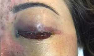 Một cô gái suýt mù mắt do tiêm filler làm đẹp