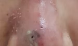 Một phụ nữ ngưng tim sau khi tiêm thuốc mê để nâng mũi 