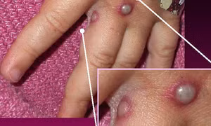 Mỹ ghi nhận ca đầu tiên mắc căn bệnh hiếm gặp đang lây lan ở châu Âu