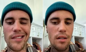 Chứng Ramsay Hunt khiến ca sĩ Justin Bieber bị liệt mặt là gì?