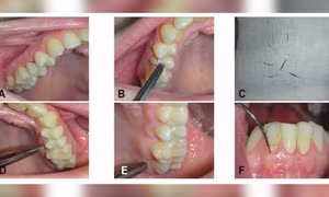 Mắc bệnh lạ, người phụ nữ mọc lông ở… lợi