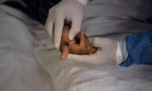 Virus đậu mùa khỉ có thể bám lâu trên các vật dụng gia đình