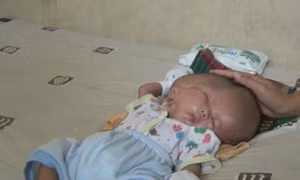 Bé sơ sinh chào đời với hai khuôn mặt, hai bộ não