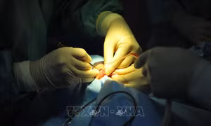 Nữ bệnh nhân bị thủng ruột non do nuốt mảnh xương khi ăn bún sườn
