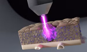 Tia plasma lạnh tiêu diệt tế bào ung thư ẩn sâu