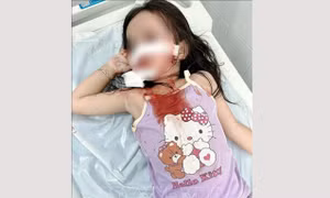 Bé gái 4 tuổi bị chó thả rông tấn công, thương tích nghiêm trọng vùng mặt