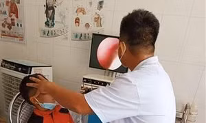 Gắp con đỉa dài khoảng 3cm trong mũi bệnh nhi 10 tuổi