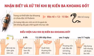 Nhận biết và xử trí khi bị kiến ba khoang đốt