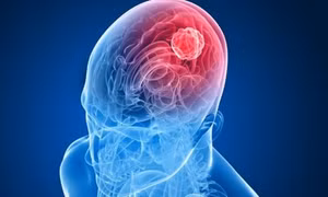 AI giúp phân loại khối u não chỉ trong vài giờ
