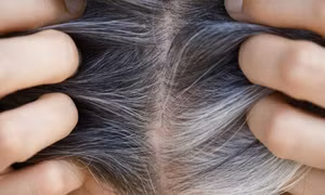 Mối liên quan giữa tóc bạc và nguy cơ ung thư