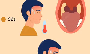 Triệu chứng của bệnh bạch hầu