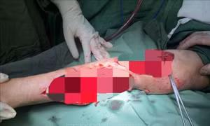 Cứu kịp thời trường hợp bị chó nhà cắn nguy hiểm đến tính mạng