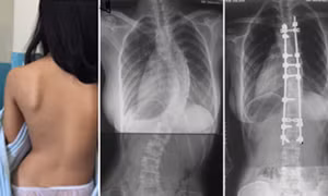 Cách nhận biết trẻ có các dấu hiệu cong vẹo cột sống