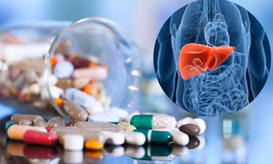 Tổn thương gan nghiêm trọng do dùng thuốc không rõ nguồn gốc​​