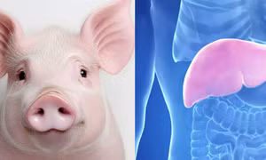 Gan lợn biến đổi gene mở ra hướng đi mới trong điều trị suy gan cấp